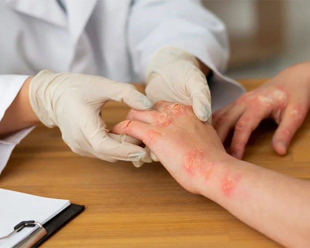 Psoriasis
